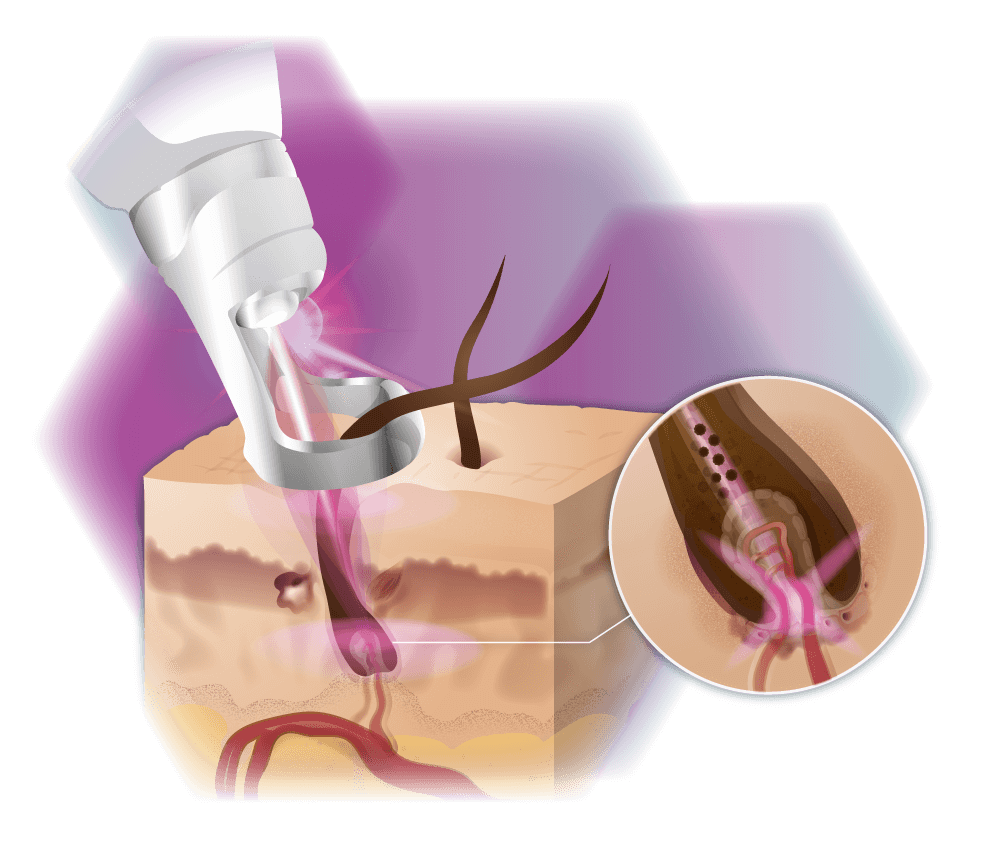 graphic Alexandritelaser Mode of action Skin cross-section