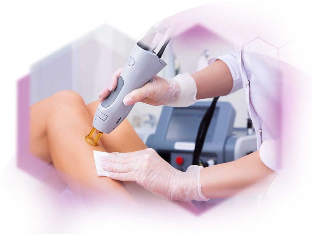 Treatment photo legs alexandrite laser