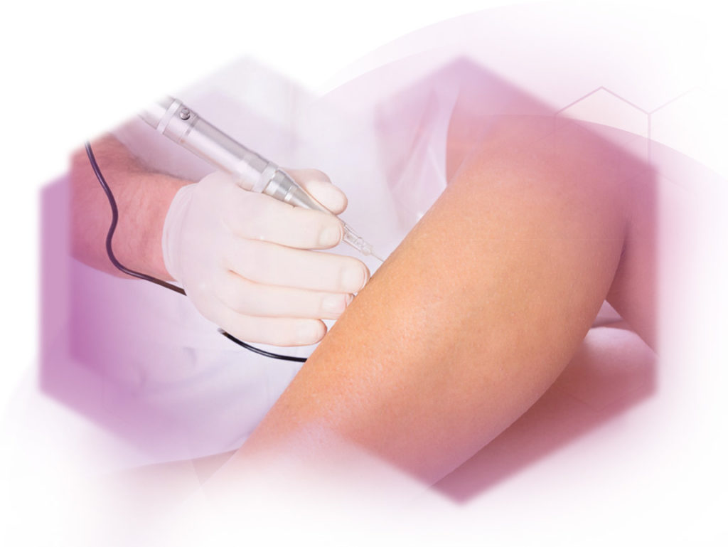 photo treatment needle epilation