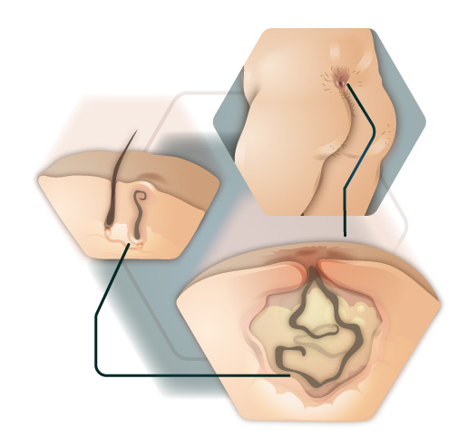 Information graphic coccyx fistula